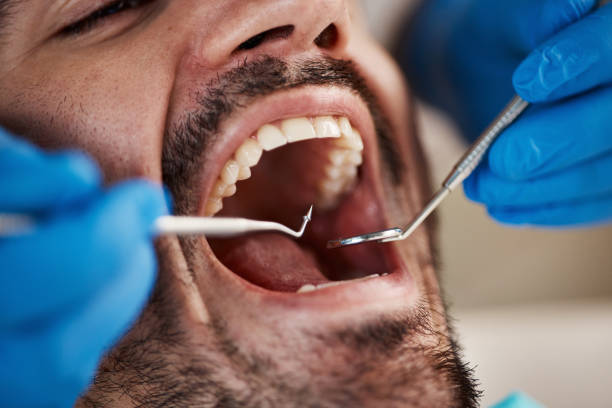 Best Emergency Broken Tooth Repair in USA